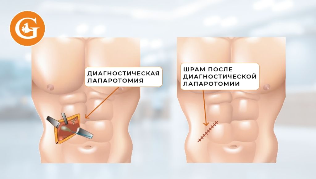 Лапаротомия диагностическая.jpeg
