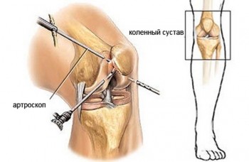 Артроскопические операции (коленный, плечевой, голеностопный суставы) в рамках ОМС