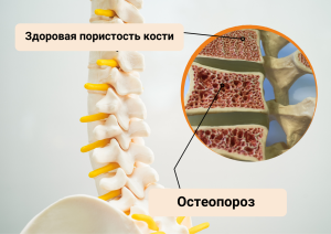 лечение-остеопороза