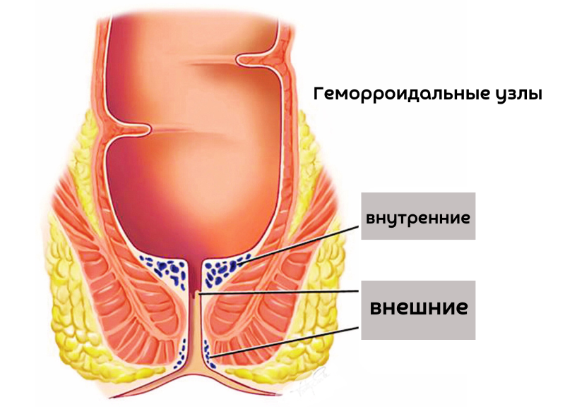 геморрой