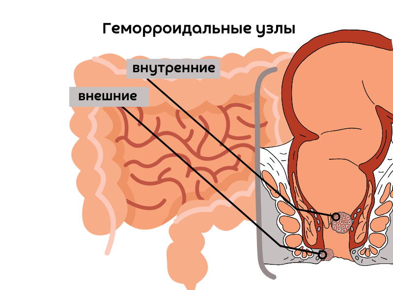 лечение-геморроя